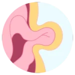 Cirugía Gastrointestinal de Urgencia en Tepic