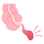 Cirugía Gastrointestinal de Urgencia en Tepic