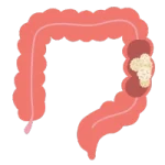 Cirugía Gastrointestinal de Urgencia en Tepic