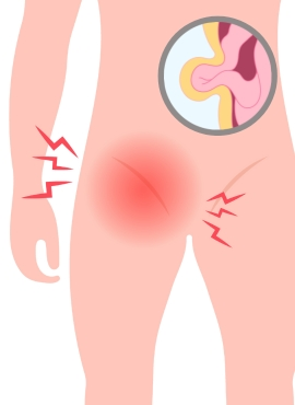 19 Cirugía de Hernia Inguinal en Tepic