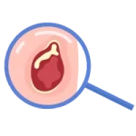 Cirugía Gastrointestinal de Urgencia en Tepic