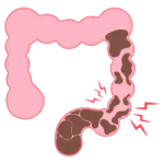 Cirugía Gastrointestinal de Urgencia en Tepic