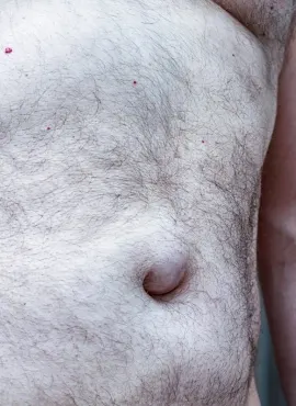 Cirugía de Hernia Umbilical en Tepic