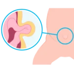 Cirugía de Hernias en Tepic 