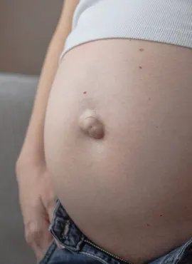 Cirugía de Hernia Umbilical en Tepic