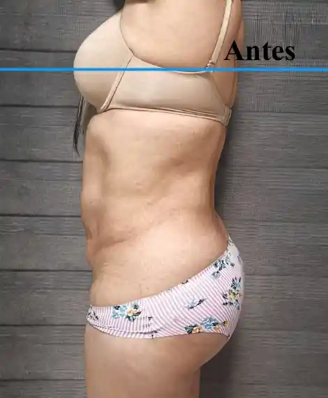 antes (2)