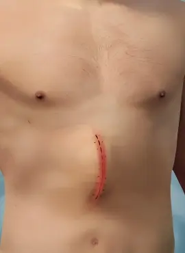 cicatriz-de-operacion-de-hernia-incisional