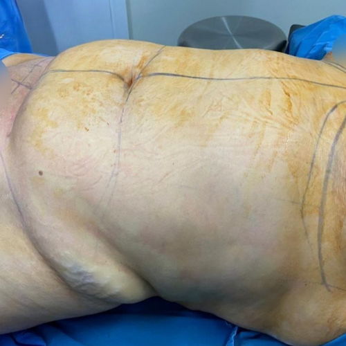 cirugia abdominoplastia en tepic