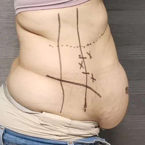 Cirugía de Hernia en Tepic