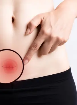 hernia-incisional