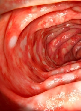 intestino Oclusión Intestinal en Tepic