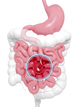 obstruccion Oclusión Intestinal en Tepic