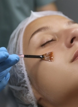 Peeling en Tepic