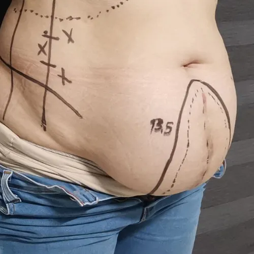 Cirugía de Hernia en Tepic