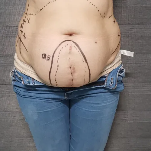 Cirugía de Hernia en Tepic